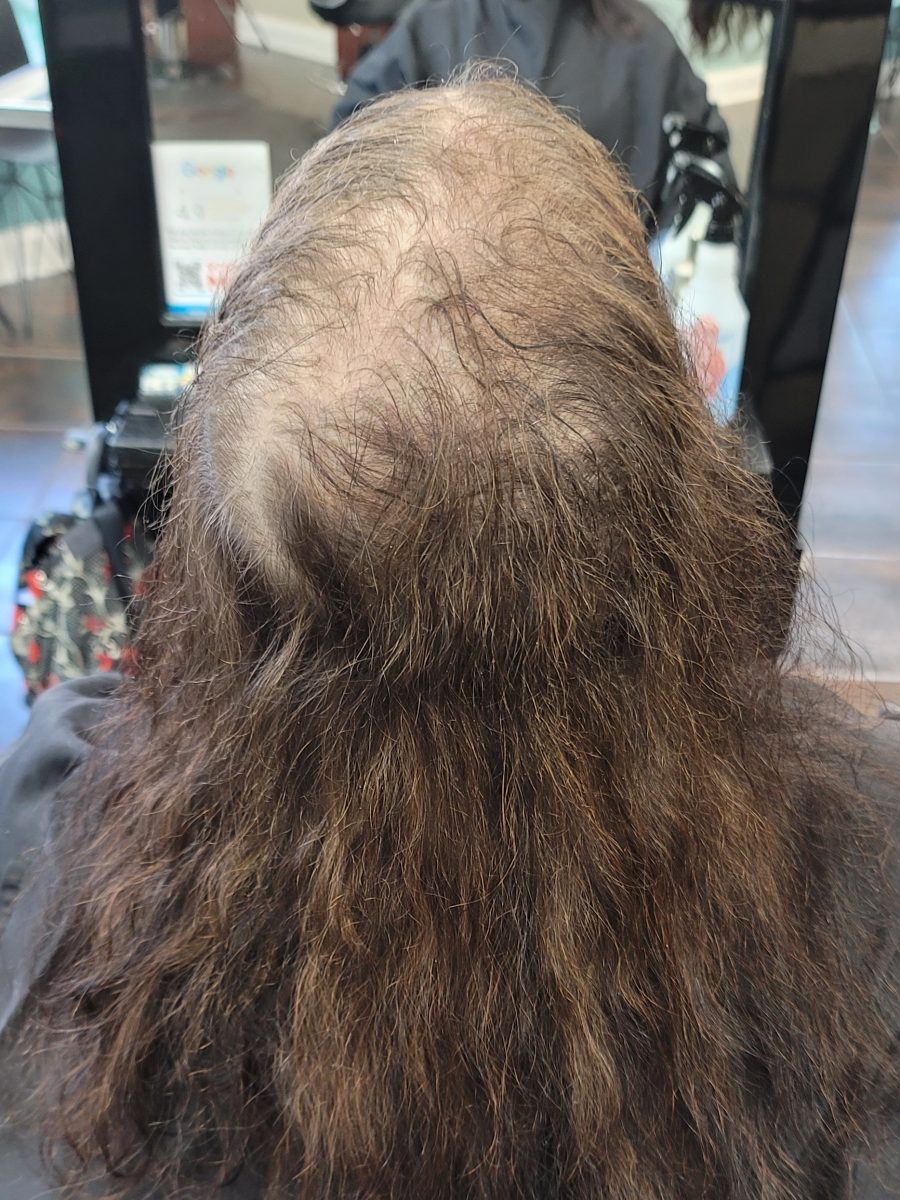 Topper Hair Replacement Installation - Before & After before treatment by certified cranial prosthesis specialist Kristan Sayers at K Bella Hair Studio in Brighton, MI