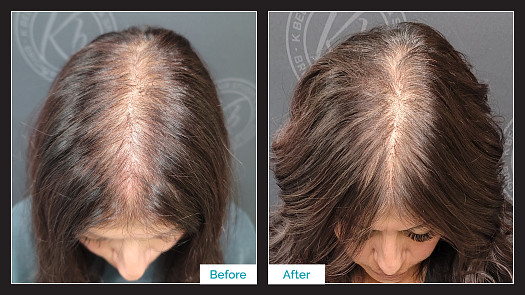 MicroPoint Non-Surgical Hair Replacement - By Kristan Sayers | K Bella - Brighton, MI
